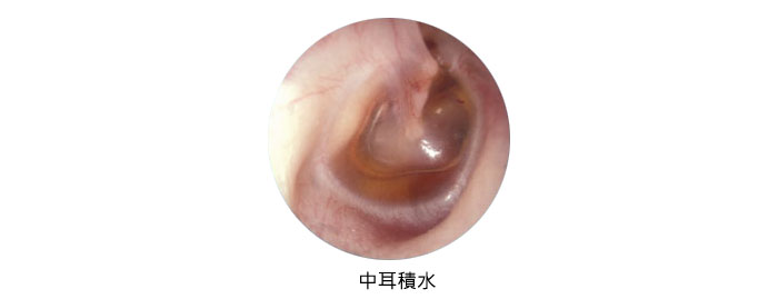 中耳積水治療 耳鼻喉 中耳炎 耳鳴 鼻咽癌 鼻竇炎 扁桃腺炎 喉癌 Hmc Ent Specialists Centre