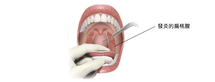腺 手術 扁桃