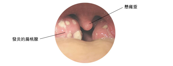 慢性扁桃腺炎