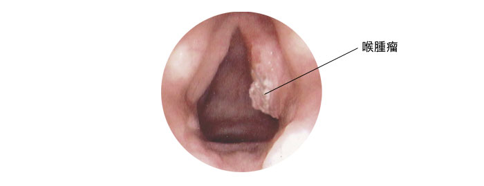 喉癌喉腫瘤