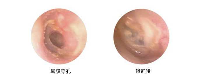 修補耳膜