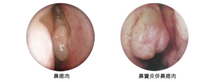 鼻瘜肉