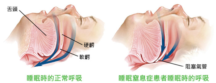 睡眠窒息症問題