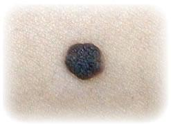 Image:Nevus1.jpg