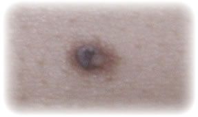 Image:Nevus2.jpg