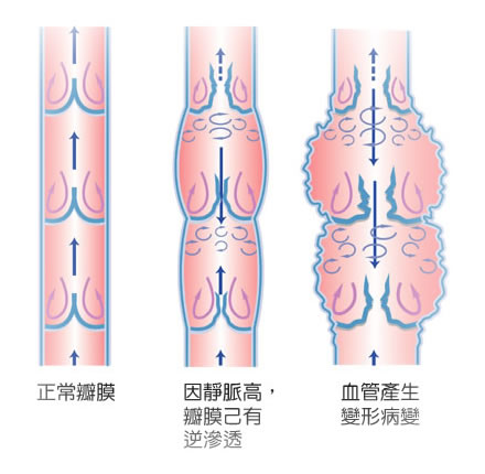 靜脈曲張對比圖